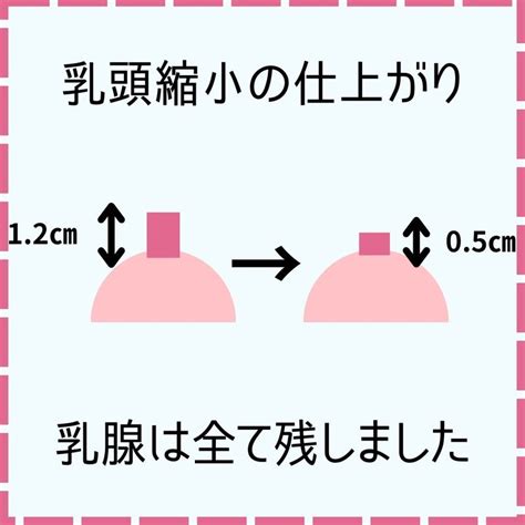 乳首でかい|乳頭がでかい・長いのは小さくできる？おすすめの乳頭縮小術や。